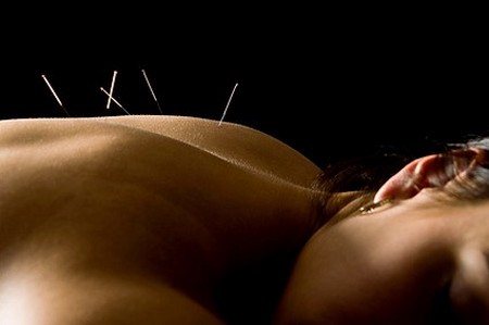 L'acupuncture : un des outils de la médecine chinoise